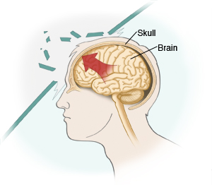 Side view of head showing brain injury.