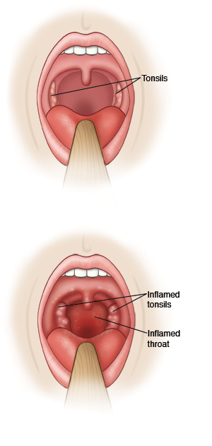 Normal throat and tonsils and inflamed tonsils and throat.
