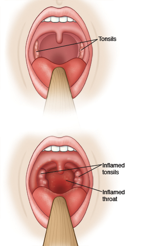 Two views of throat, one showing normal tonsils and one showing inflamed tonsils and throat.