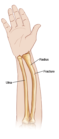 Bones of the forearm, radius and ulna, with fracture on radius.