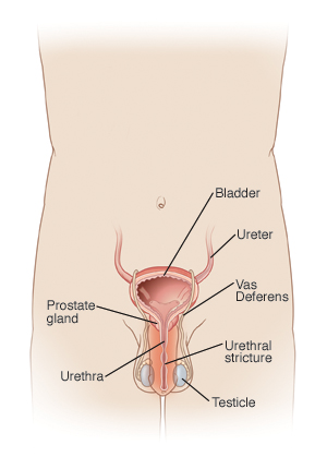 Front view of male pelvis, showing bladder, ureters, vas derens, prostate gland, testicles, and urethra with urethral stricture.