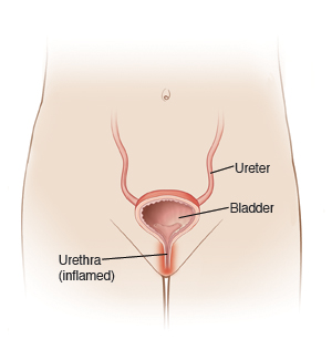 Front view of female child's pelvis, showing bladder, ureters, and inflamed urethra.