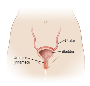 Female urinary tract, showing ureter, bladder, and inflamed urethra.