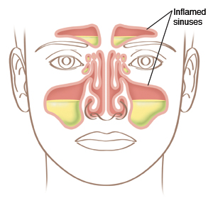 Front view of face showing inflamed sinuses.