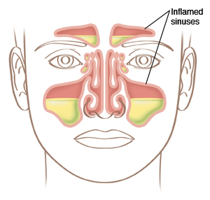 Face showing inflamed sinuses.