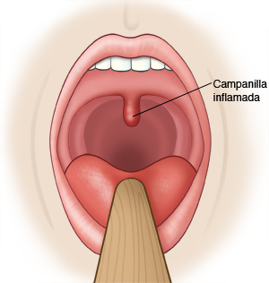 Boca abierta con la lengua retenida por un depresor lingual donde se ve una úvula inflamada.