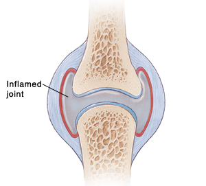 Close-up of inflamed joint.