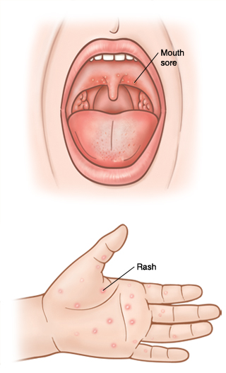 Mouth sores and rash on hand.