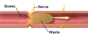 Bowel with waste moving through it, showing nerve activity causing pain in bowel.