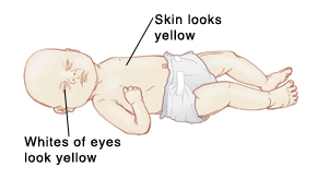 Newborn baby with jaundice, showing yellow skin and yellow whites of eyes.