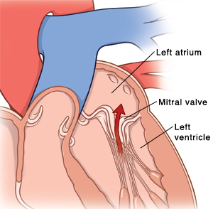 Inside view of heart showing blood flowing from left ventricle to left atrium through mitral valve.