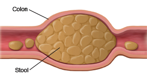 Cross section of colon showing hard stool inside.