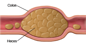 Corte transversal del colon con heces duras en el interior.