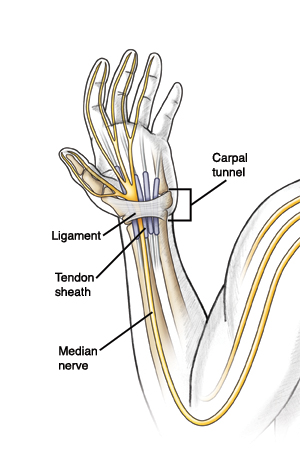 Internal view of arm and hand, showing the median nerve, tendon sheath, and the ligament that forms the carpal tunnel at the wrist.