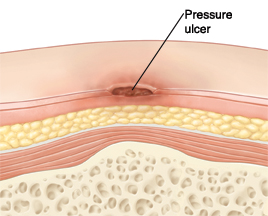 Úlcera por presión en la piel