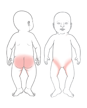 Front and back views of baby showing diaper rash on buttocks, on inner thigh, and in fold where legs meet trunk. 