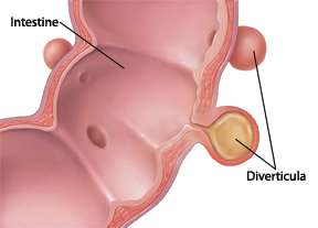 Cross-section of an intestine showing a diverticula pouch in the intestinal wall.