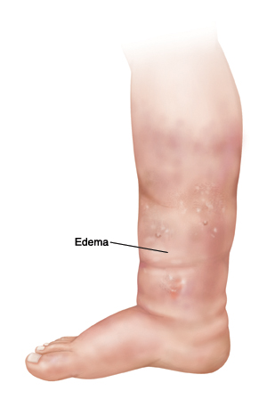 Leg, ankle, and foot with edema.