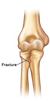 Bones of elbow, with broken bone.