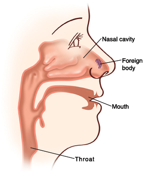 Childs nasal passages and throat