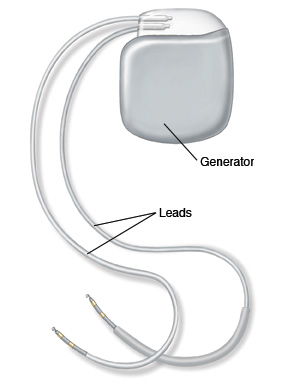 ICD generator and leads.