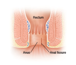 Front view cross section of anus showing anal fissure.