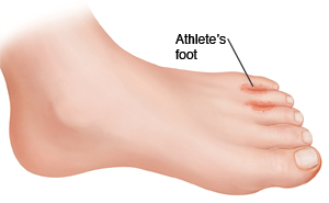 Foot with red patches of athlete's foot between toes.