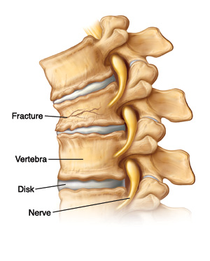 Vertebrae showing fracture, disk, and nerve.