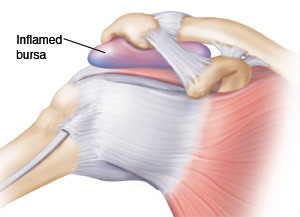 Shoulder joint showing muscles and ligaments and inflamed bursa.