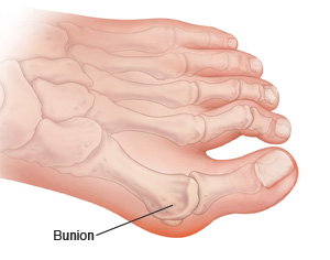 The foot and its bones, showing a bunion.
