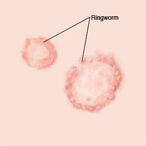 Ringworm on skin.