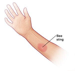 Imagen de un brazo en donde se observa una picadura de abeja.