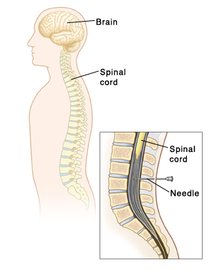 The brain and spinal cord, showing spinal tap with detail of needle placed into spinal canal.