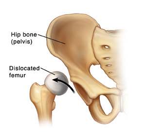 The hip with a dislocated femur.