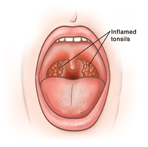 Front view of open mouth showing inflamed throat and tonsils.