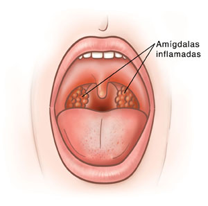 Vista frontal de la boca abierta que muestra inflamación de garganta y amígdalas.