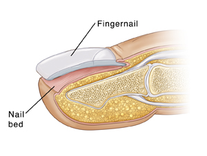 Cross section of fingertip showing complete detachment of fingernail.