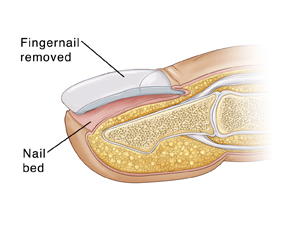 Cross section of fingertip, showing fingernail removal and the nail bed.