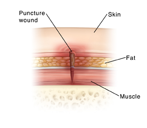 Cross section of skin showing skin, fat, and muscle layers and a puncture wound penetrating all layers.