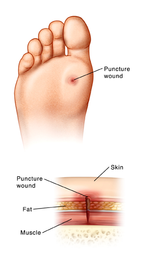 Sole of foot with puncture wound, with detail cross section showing puncture through layer of skin, fat, and muscle.
