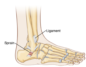 An outline of the foot showing the bones, the ligament, and the location of the ankle sprain.