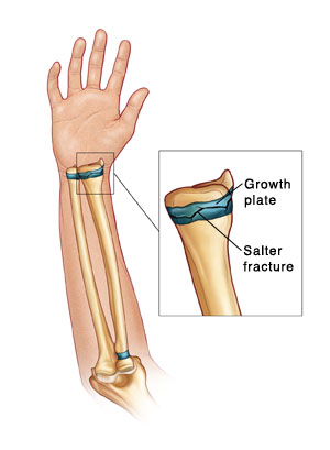 Bones of forearm, with detail of growth plate and Salter fracture.
