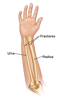 Bones of forearm, showing fractures in both ulna and radius.