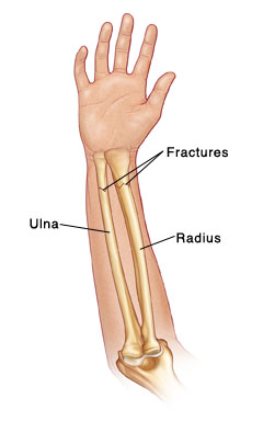 Fractures in bones of the forearm, the ulna and the radius.