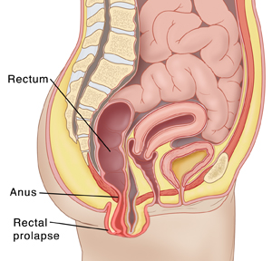 Cross section of lower trunk of body showing rectal prolapse.