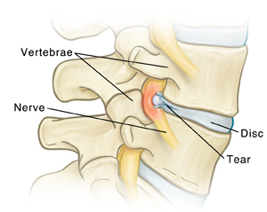 Close-up of spine showing vertebrae, nerves, and disc with a tear.