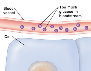 Cell with close-up of blood vessel with too much glucose in bloodstream.