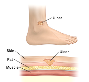 Ulcer on ankle with detail of ulcer penetrating skin layer.