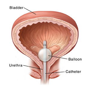 Front view cross section of bladder and urethra. Catheter is inserted through urethra into bladder. Balloon on end of catheter holds catheter in place in bladder.