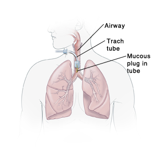 Respiratory system, showing airway, trach tube, and mucous plug in tube.